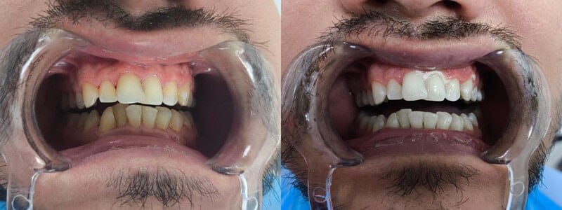 Get the smile you've always wanted - Dentist in Turkey
