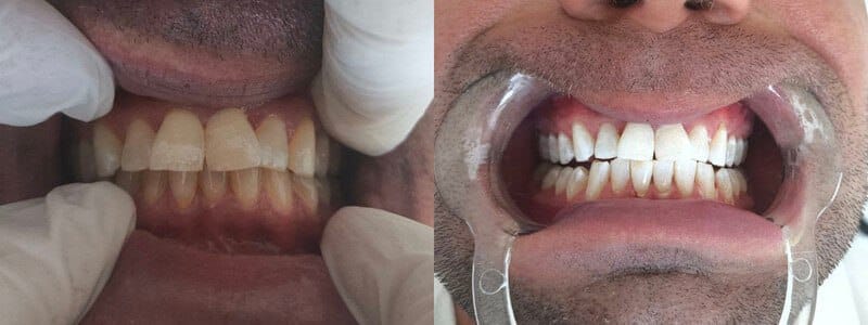 Professional teeth whitening - Dentist in Turkey