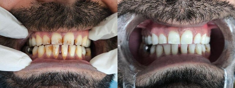 See the shades of difference - Dentist in Turkey