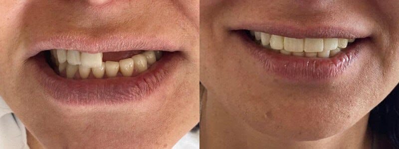 Get Zirconium coatings with your trusted dentist in Turkey