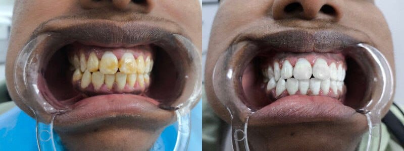 Say goodbye to stains - Dentist in Turkey
