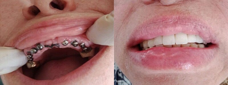 Restore your smile's foundation - Dentist in Turkey