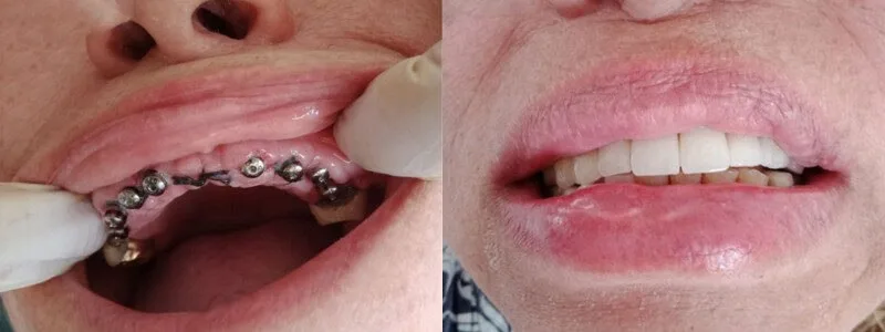 Restore your smile's foundation - Dentist in Turkey