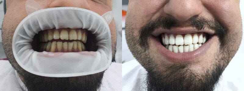 Brighten your smile - Dentist İn Turkey