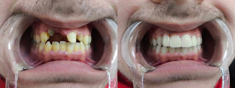 Upper Front Teeth Zirconium Coating in Turkey