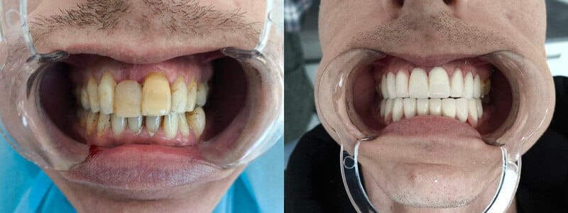 Zirconium Coating in the Best Clinic Turkey - DentaSide