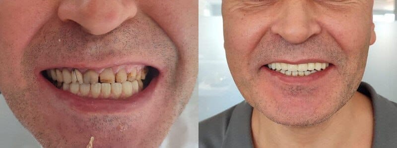 You can also get this service "Zirconium Coating in Turkey"