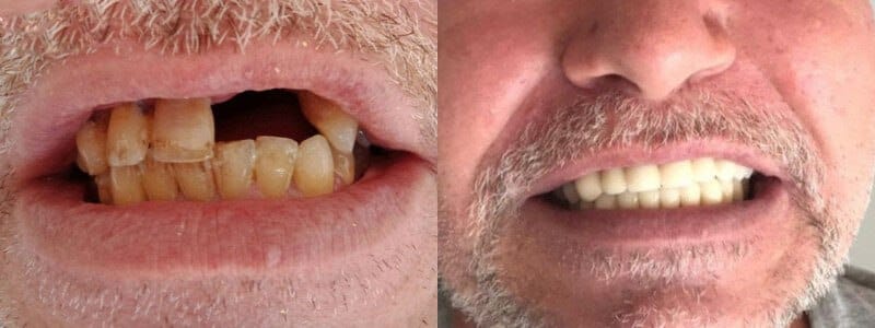 You can also get this service "Zirconium Coating in Turkey"