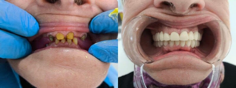 Porcelain veneers with the best prices in turkey