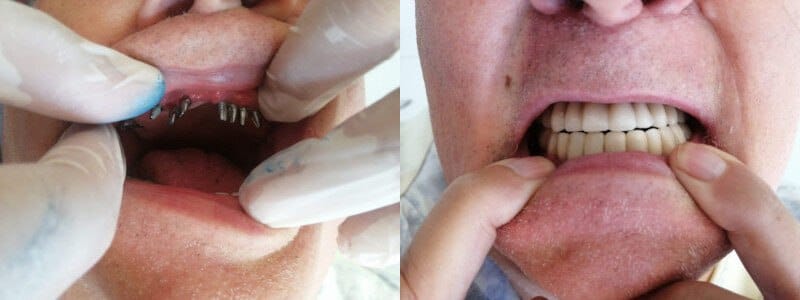 Transform your life, one implant at a time - Dentist in Turkey