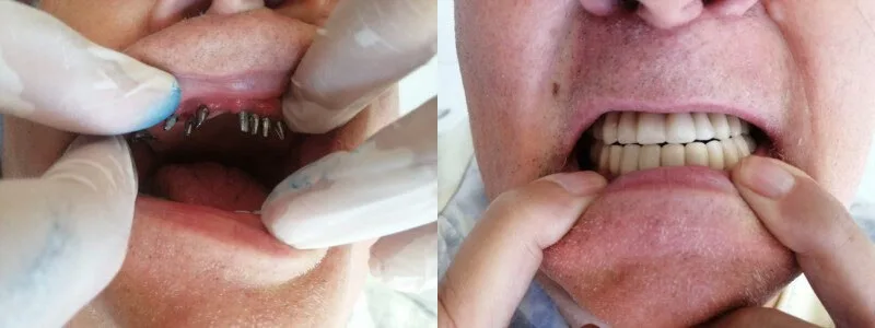 Transform your life, one implant at a time - Dentist in Turkey