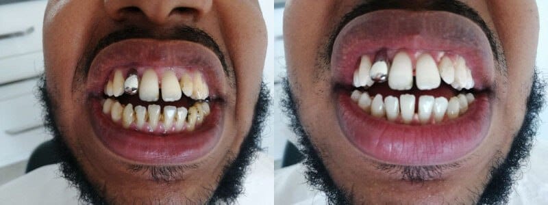 Discover the magic of professional teeth whitening with dentist in Turkey