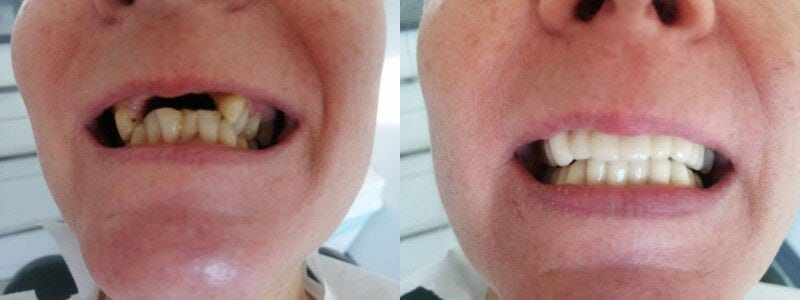 Zirconium Bridge in the Best Clinic Turkey