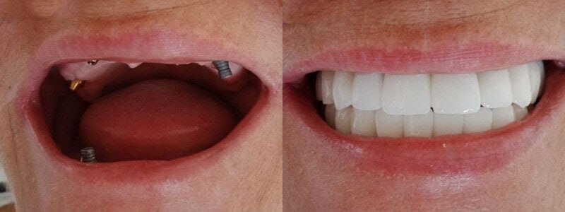 Dentist in Turkey - Regain your natural smile and bite