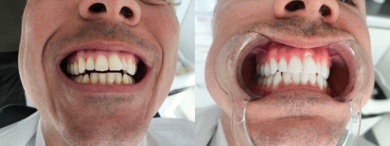 Reveal a younger, more vibrant smile - Dentist in Turkey