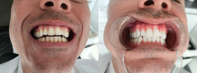 Reveal a younger, more vibrant smile - Dentist in Turkey