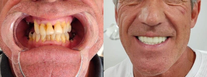 Zirconium Coating in the Best Clinic Turkey